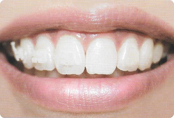 歯の色に近いブラケット（invu）