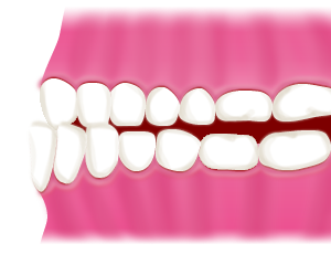 受け口/反対咬合（はんたいこうごう）